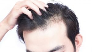 dade recomendada para transplante capilar