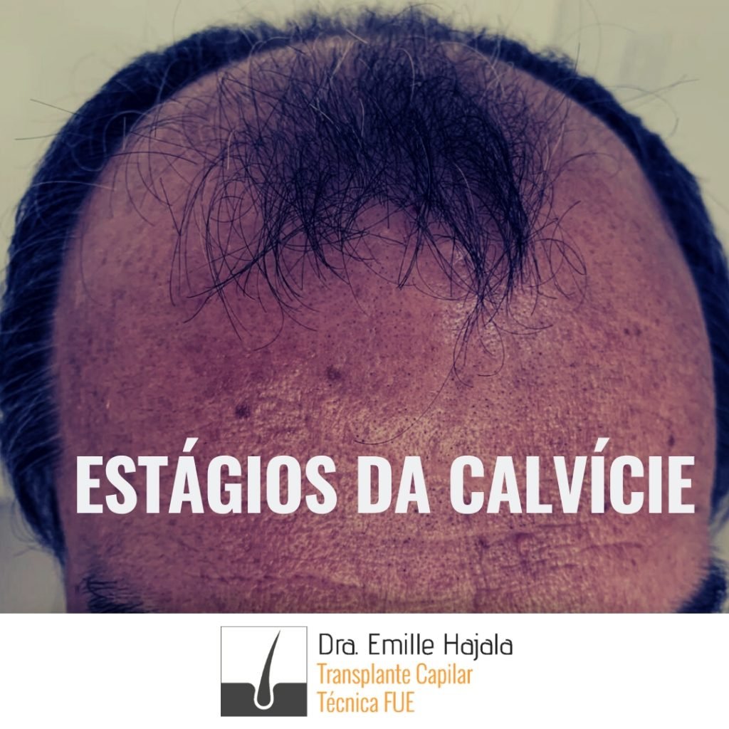 estágios da calvície