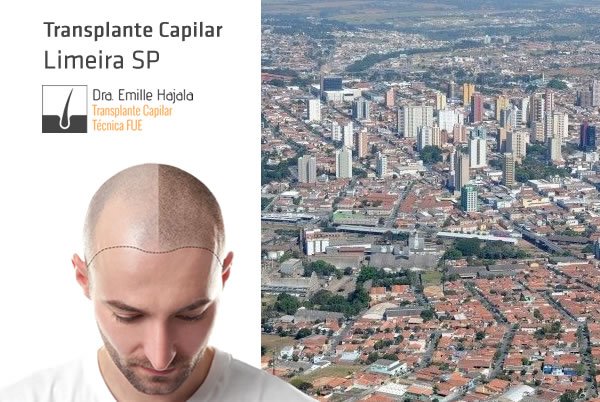 Transplante capilar em Limeira (SP)