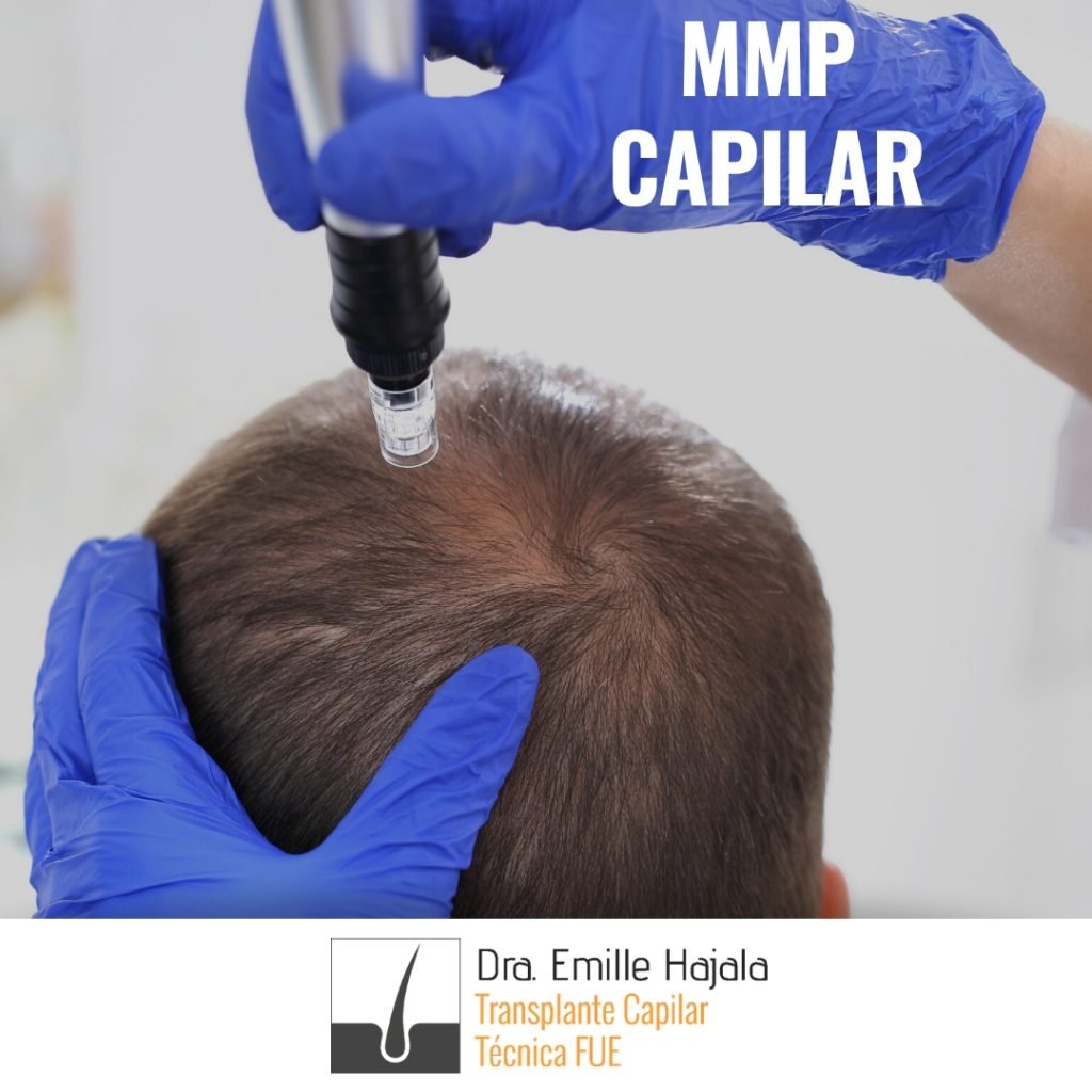 mmp capilar